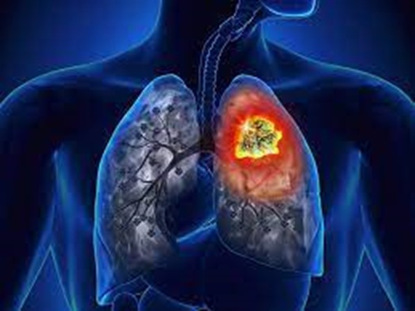 Tầm soát Ung thư phổi – Những điều cần biết?