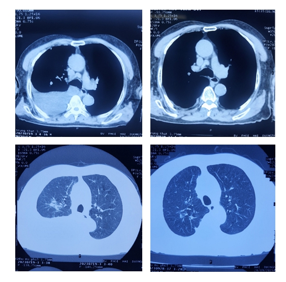 Case bệnh ung thư phổi giai đoạn IV tại khoa U bướu bệnh viện Phổi Hải Dương đáp ứng sau điều trị hoá chất